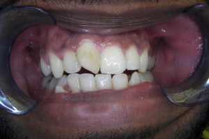 Before- Veneers Dentist in New Brunswick